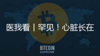 医我看丨罕见
！心脏长在右胸膛！珠海成功开展首例“右位心”房颤射频消融术