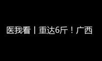 医我看丨重达6斤	
！广西女子乳腺肿瘤2年疯长至篮球大，医生提醒�：这些情况务必重视