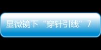 显微镜下“穿针引线”7小时！金湾这家医院成功帮患者保住断肢